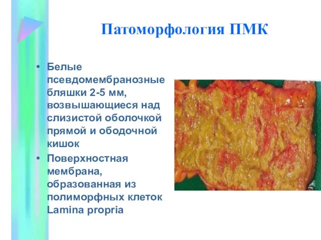 Патоморфология ПМК Белые псевдомембранозные бляшки 2-5 мм, возвышающиеся над слизистой оболочкой