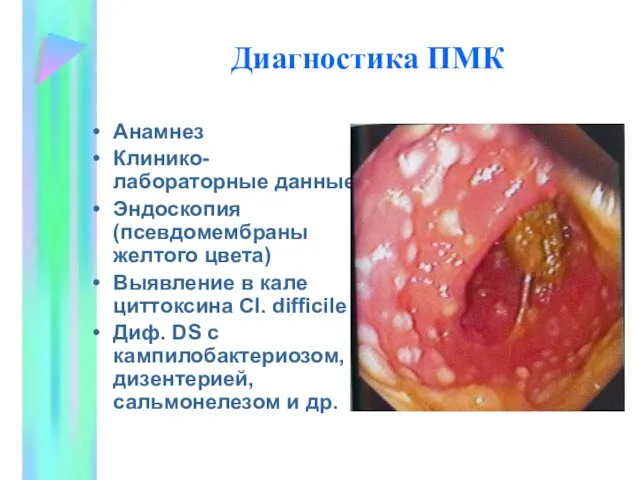 Диагностика ПМК Анамнез Клинико-лабораторные данные Эндоскопия (псевдомембраны желтого цвета) Выявление в