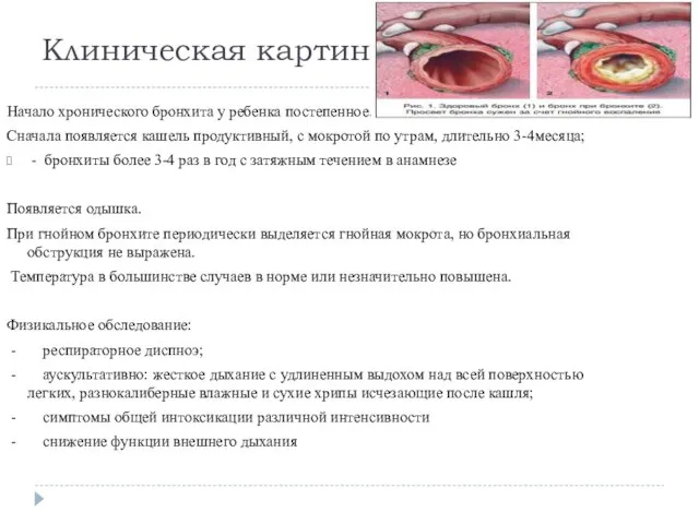 Клиническая картина: Начало хронического бронхита у ребенка постепенное. Сначала появляется кашель