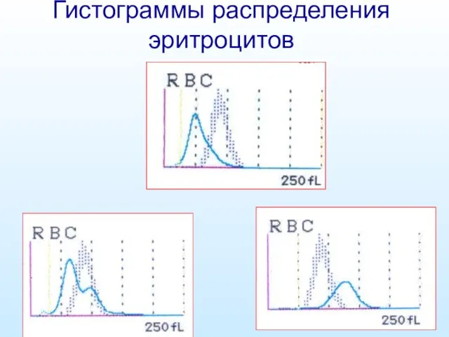 Гистограммы распределения эритроцитов