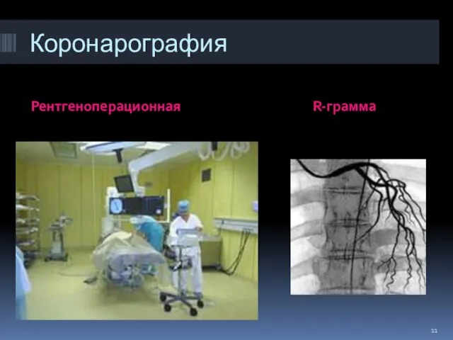 Коронарография Рентгеноперационная R-грамма