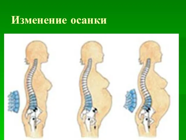 Изменение осанки