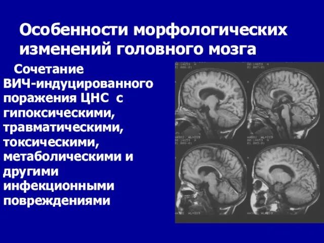 Особенности морфологических изменений головного мозга Сочетание ВИЧ-индуцированного поражения ЦНС с гипоксическими,