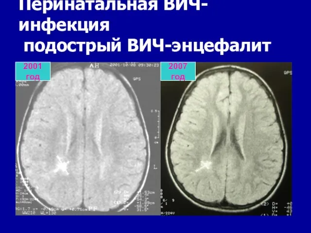 Перинатальная ВИЧ-инфекция подострый ВИЧ-энцефалит 2001 год 2007 год