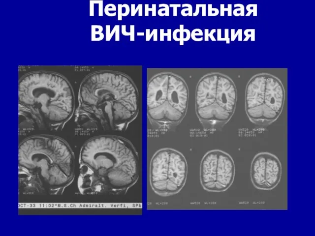 Перинатальная ВИЧ-инфекция