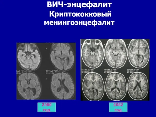 Перинатальное поражение ЦНС ВИЧ-энцефалит Криптококковый менингоэнцефалит 2000 год 2002 год