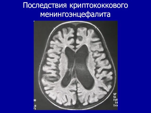 Последствия криптококкового менингоэнцефалита