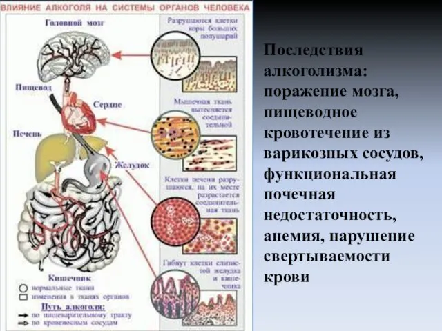 Последствия алкоголизма: поражение мозга, пищеводное кровотечение из варикозных сосудов, функциональная почечная недостаточность, анемия, нарушение свертываемости крови