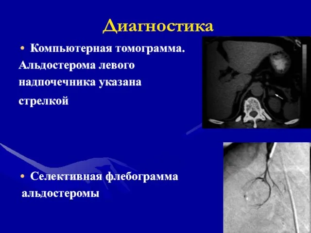 Компьютерная томограмма. Альдостерома левого надпочечника указана стрелкой Селективная флебограмма альдостеромы Диагностика