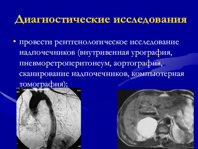 Диагностические исследования провести рентгенологическое исследование надпочечников (внутривенная урография, пневморетроперитонеум, аортография, сканирование надпочечников, компьютерная томография);