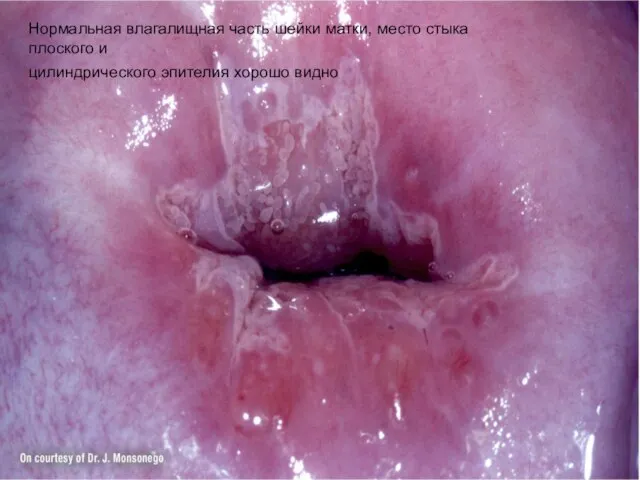 Нормальная влагалищная часть шейки матки, место стыка плоского и цилиндрического эпителия хорошо видно
