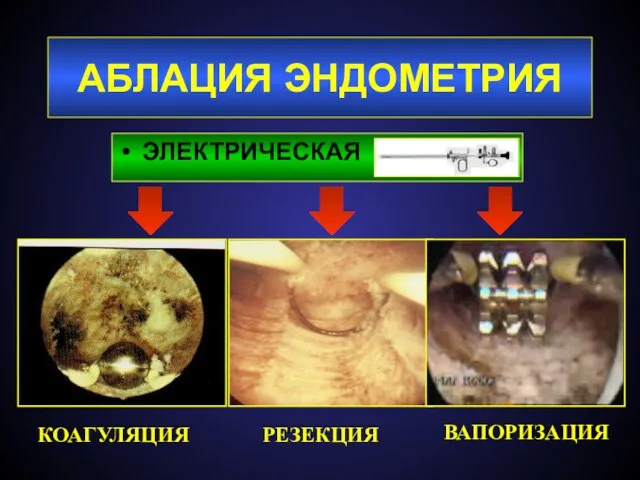 АБЛАЦИЯ ЭНДОМЕТРИЯ ЭЛЕКТРИЧЕСКАЯ РЕЗЕКЦИЯ ВАПОРИЗАЦИЯ КОАГУЛЯЦИЯ