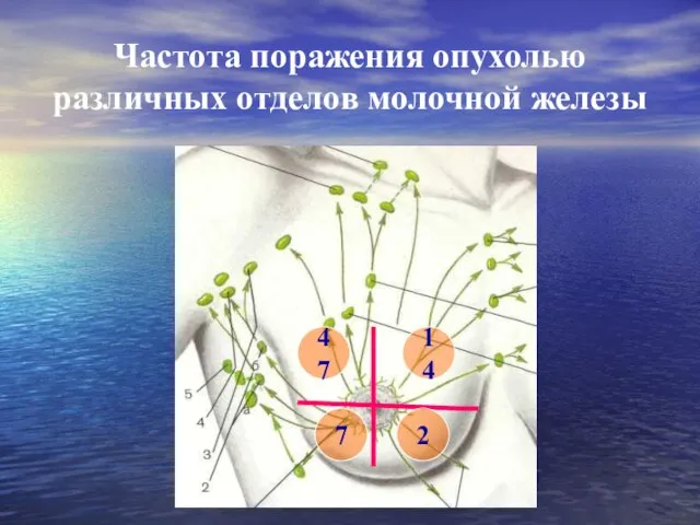 Частота поражения опухолью различных отделов молочной железы 47 14 2 7