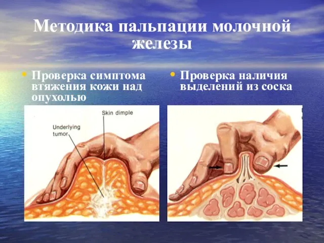 Методика пальпации молочной железы Проверка симптома втяжения кожи над опухолью Проверка наличия выделений из соска