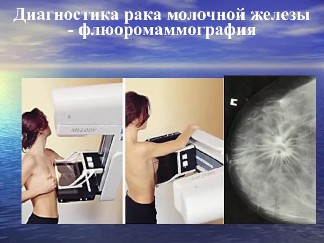 Диагностика рака молочной железы - флюоромаммография