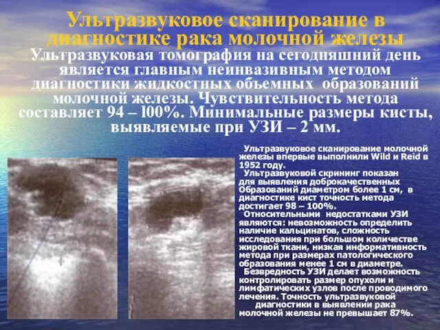 Ультразвуковое сканирование в диагностике рака молочной железы Ультразвуковая томография на сегодняшний