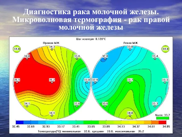 Диагностика рака молочной железы. Микроволновая термография - рак правой молочной железы