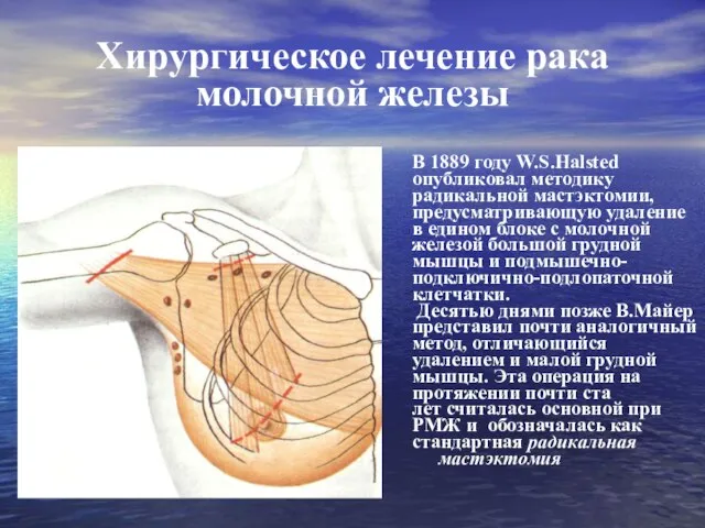 Хирургическое лечение рака молочной железы В 1889 году W.S.Halsted опубликовал методику