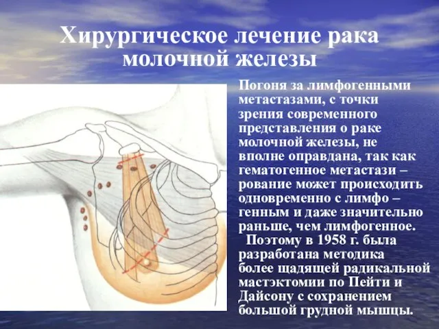 Хирургическое лечение рака молочной железы Погоня за лимфогенными метастазами, с точки