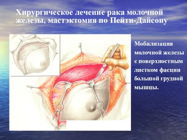 Хирургическое лечение рака молочной железы, мастэктомия по Пейти-Дайсону Мобилизация молочной железы