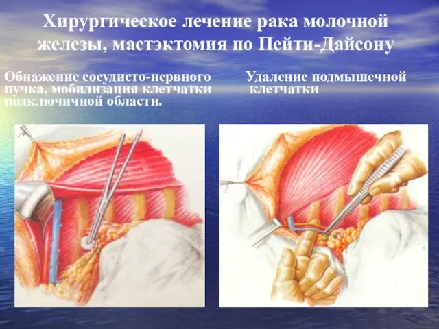 Хирургическое лечение рака молочной железы, мастэктомия по Пейти-Дайсону Обнажение сосудисто-нервного пучка,