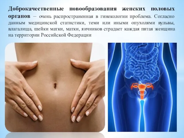 Доброкачественные новообразования женских половых органов – очень распространенная в гинекологии проблема.