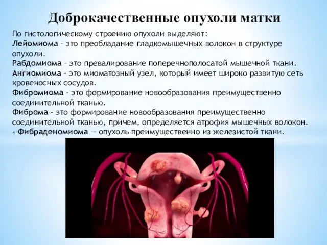 Доброкачественные опухоли матки По гистологическому строению опухоли выделяют: Лейомиома – это