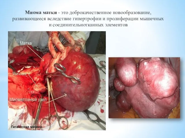 Миома матки - это доброкачественное новообразование, развивающееся вследствие гипертрофии и пролиферации мышечных и соединительнотканных элементов
