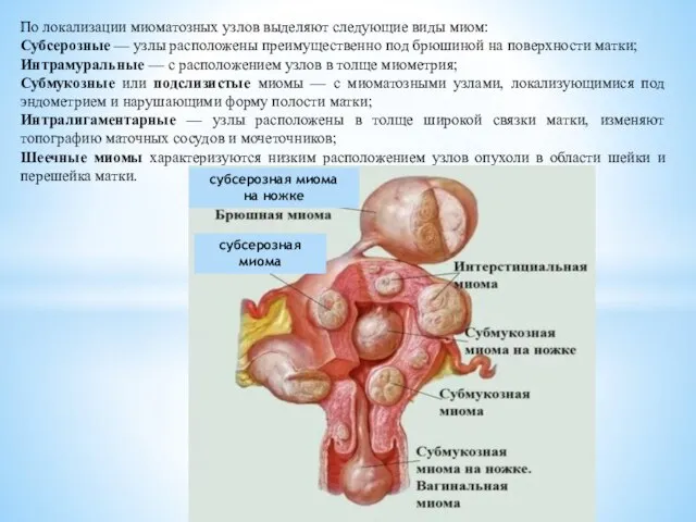 По локализации миоматозных узлов выделяют следующие виды миом: Субсерозные — узлы