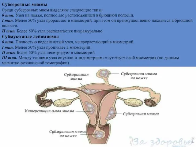 Субсерозные миомы Среди субсерозных миом выделяют следующие типы: 0 тип. Узел