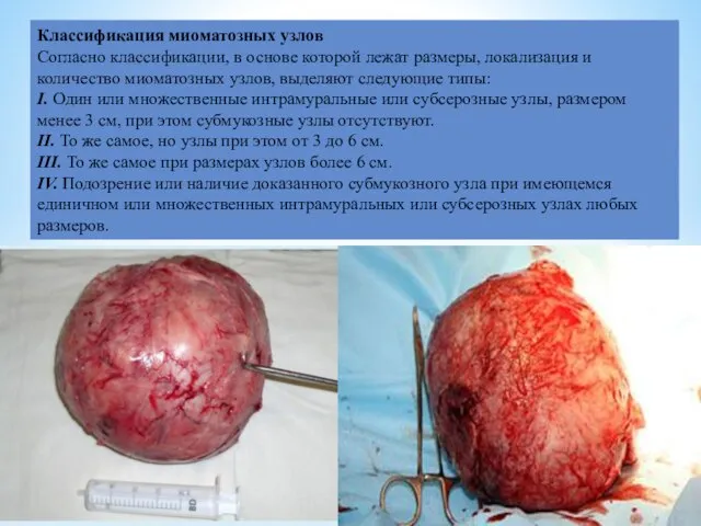 Классификация миоматозных узлов Согласно классификации, в основе которой лежат размеры, локализация