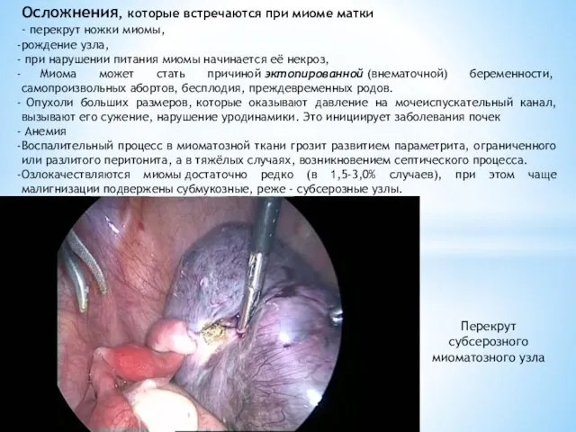 Осложнения, которые встречаются при миоме матки - перекрут ножки миомы, рождение