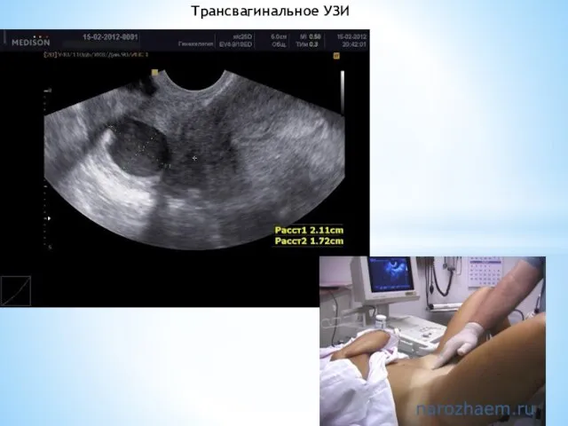 Трансвагинальное УЗИ