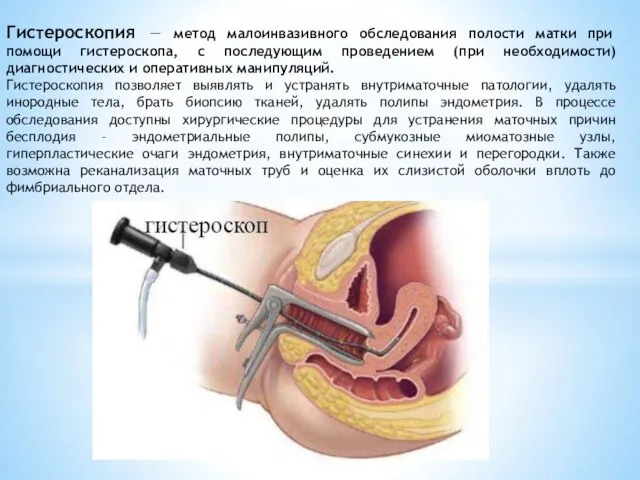 Гистероскопия — метод малоинвазивного обследования полости матки при помощи гистероскопа, с