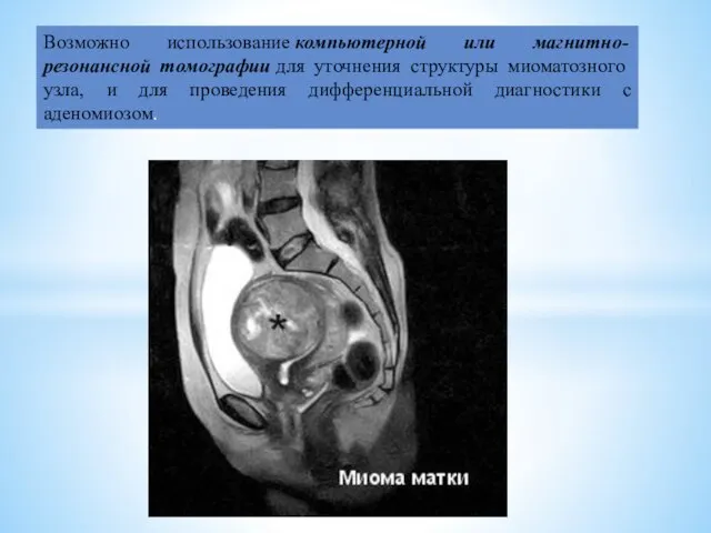 Возможно использование компьютерной или магнитно-резонансной томографии для уточнения структуры миоматозного узла,