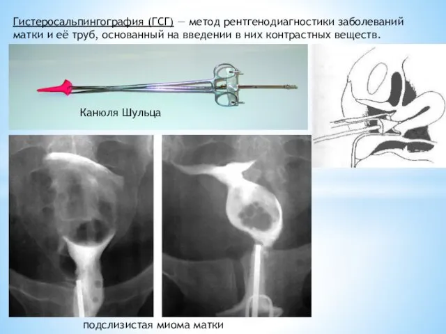 подслизистая миома матки Гистеросальпингография (ГСГ) — метод рентгенодиагностики заболеваний матки и