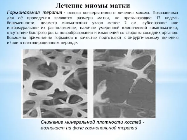 Лечение миомы матки Гормональная терапия - основа консервативного лечения миомы. Показаниями