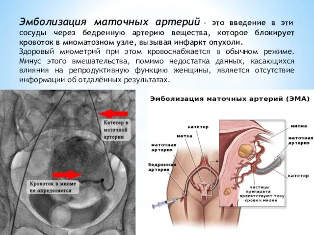 Эмболизация маточных артерий - это введение в эти сосуды через бедренную