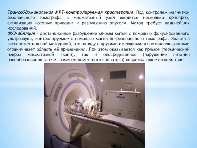 Трансабдоминальная МРТ-контролируемая криотерапия. Под контролем магнитно-резонансного томографа в миоматозный узел вводится