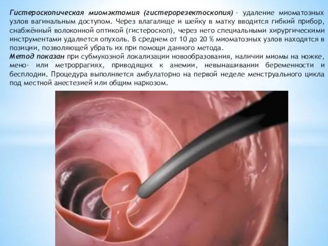 Гистероскопическая миомэктомия (гистерорезектоскопия) - удаление миоматозных узлов вагинальным доступом. Через влагалище