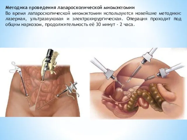 Методика проведения лапароскопической миомэктомии Во время лапароскопической миомэктомии используются новейшие методики: