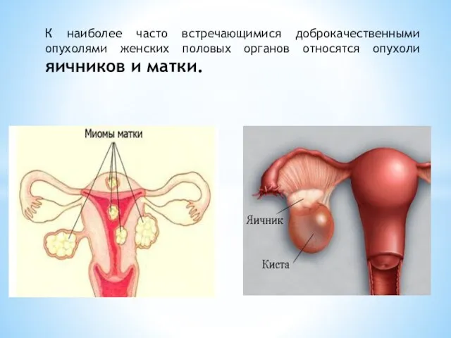 К наиболее часто встречающимися доброкачественными опухолями женских половых органов относятся опухоли яичников и матки.