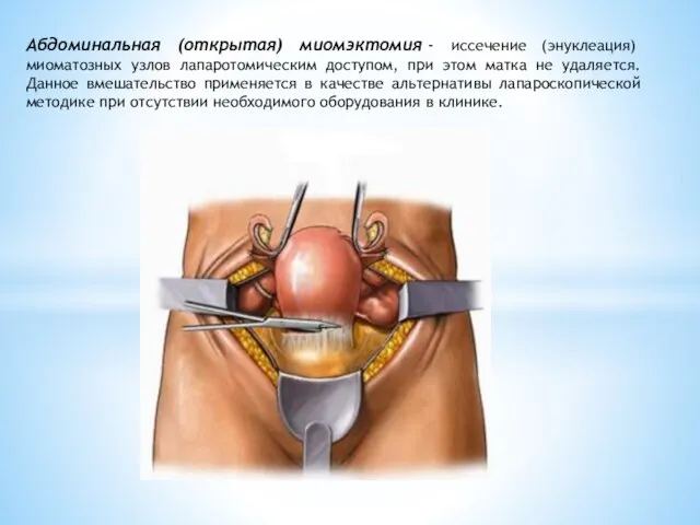 Абдоминальная (открытая) миомэктомия - иссечение (энуклеация) миоматозных узлов лапаротомическим доступом, при