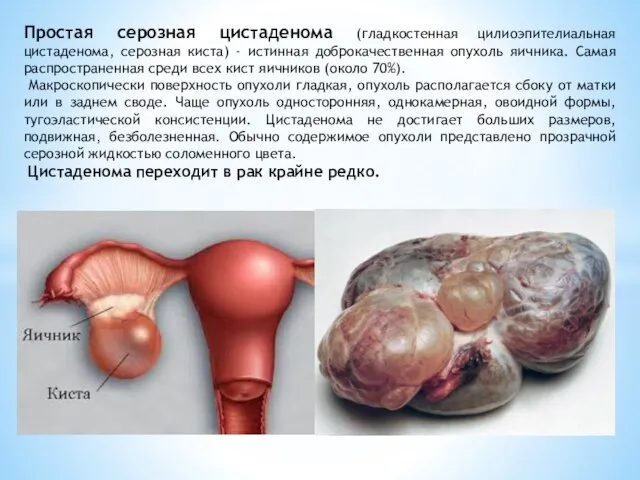 Простая серозная цистаденома (гладкостенная цилиоэпителиальная цистаденома, серозная киста) - истинная доброкачественная