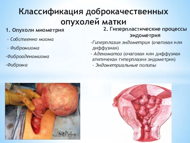 Классификация доброкачественных опухолей матки 1. Опухоли миометрия Гиперплазия эндометрия (очаговая или