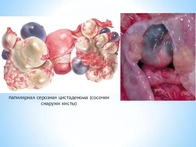 папилярная серозная цистаденома (сосочки снаружи кисты)