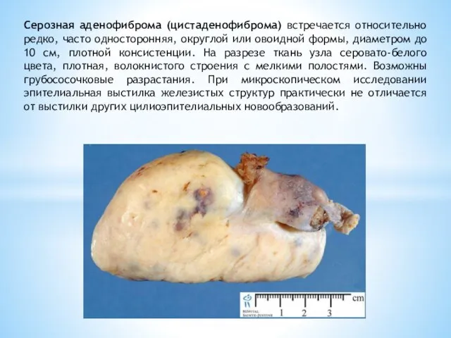 Серозная аденофиброма (цистаденофиброма) встречается относительно редко, часто односторонняя, округлой или овоидной