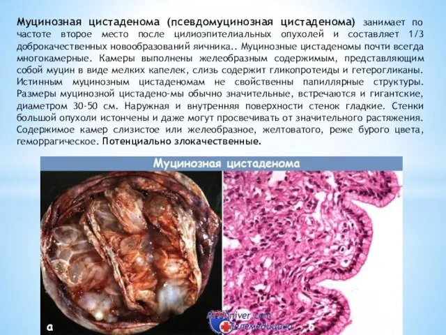 Муцинозная цистаденома (псевдомуцинозная цистаденома) занимает по частоте второе место после цилиоэпителиальных