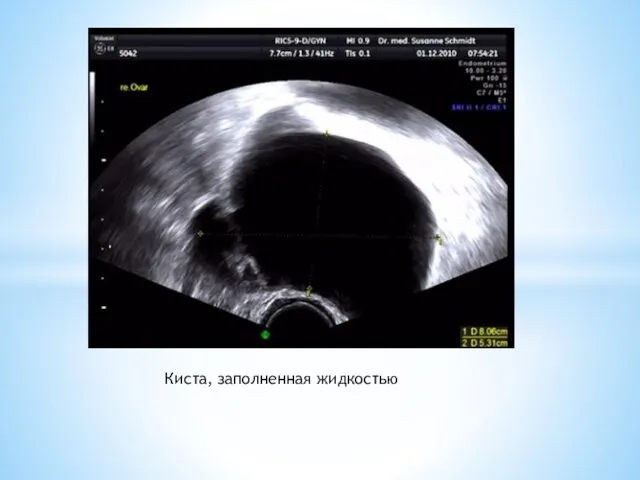 Киста, заполненная жидкостью