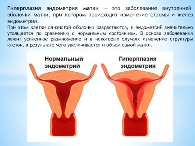 Гиперплазия эндометрия матки — это заболевание внутренней оболочки матки, при котором